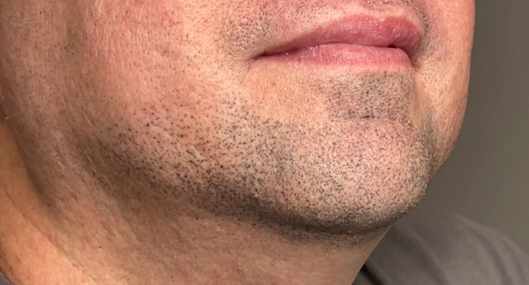 Servicio Siluetas & Sombras - Micropigmentación de Barba