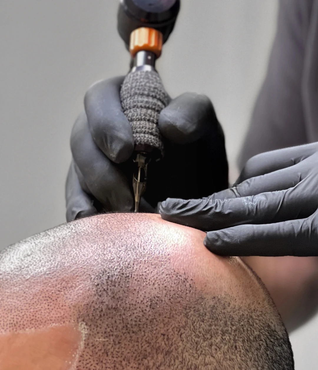 Servicio Siluetas & Sombras - Scalp Micropigmentation