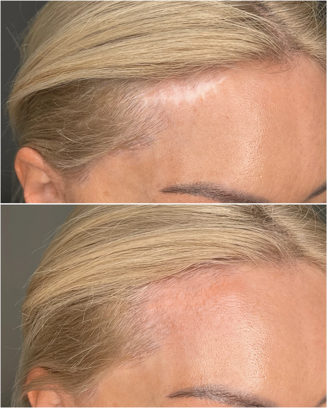 Servicio Tratamientos paramédicos - Camuflaje de cicatrices