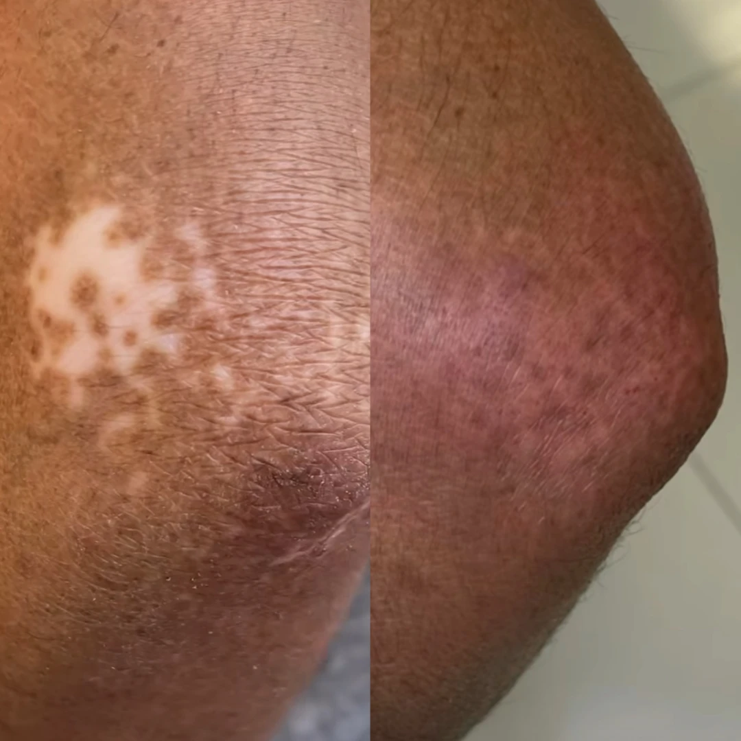 Servicio Tratamientos paramédicos - Camuflaje vitiligo